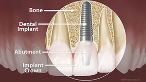 Lee s Summit Dental Restorations